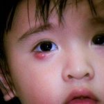 Халязион. халязион верхнего и нижнего века. как выглядит халязион