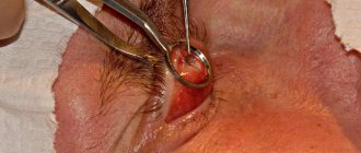 Хирургическое удаление халязиона верхнего или нижнего века глаза