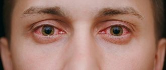 Хроническая форма конъюнктивита глаз