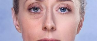 How to get rid of dark circles under the eyes in one day at home