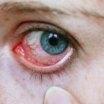 how to treat viral conjunctivitis