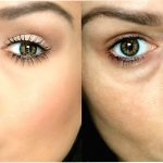 Как убрать мешки под глазами?