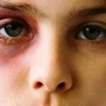 how to remove dark circles under the eyes