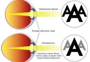 Как видит человек со зрением минус 2 и можно ли восстановить остроту зрения при таком диагнозе?