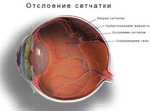 Как выглядит отслоение сетчатки внутри глаза?