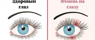 What does stye look like on the eye?