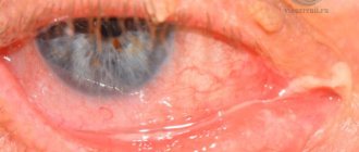 Каналикулит - боль в уголке глаза