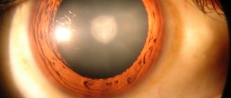 Cataract is a solar “eclipse” of the lens. © Rakesh Ahuja, MD