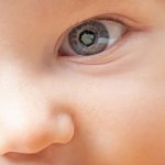 катаракта у детей причины