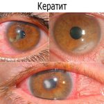 Кератит - симптомы