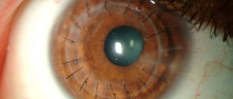Keratoplasty - types (end-to-end, layer-by-layer, etc.)