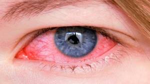 Конъюнктивит — один из распространенных глазных недугов