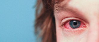 Conjunctivitis is one of the most common diseases