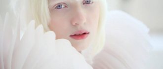 Красные глаза у альбиноса