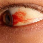 Кровоизлияние в глазу
