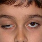 лагофтальм