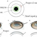 Лазерная операция на глаза ReLEx SMILE СМАЙЛ в Москве