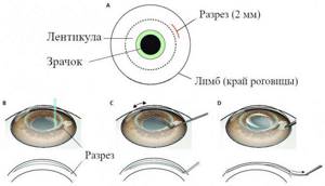 Лазерная операция на глаза ReLEx SMILE СМАЙЛ в Москве