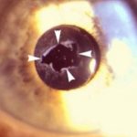 Лазерное лечение катаракты через операцию по удалению хрусталика