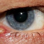 Treatment of stye - medications (medicines)
