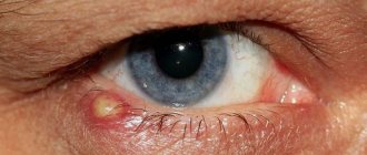Treatment of stye - medications (medicines)