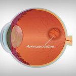 Макулодистрофия глаза