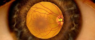 Macular edema of the retina