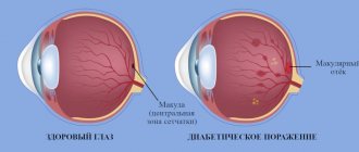 Макулярный отёк сетчатки глаза