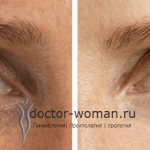 Мезотерапия вокруг глаз до и после