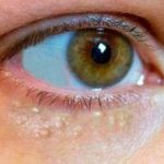 милиум на веке