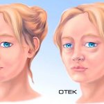 Diuretics for facial swelling. The best harmless tablets of the new generation 