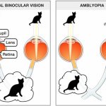 Нарушение бинокулярного зрения при амблиопии: мозг игнорирует картинки от слабовидящего глаза