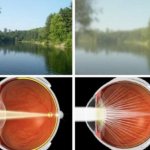 Нарушение видения