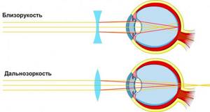 Очки — это своеобразный фильтр, который преломляет световые лучи и направляет их в нужное место сетчатки