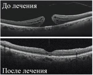ОКТ до и после лечения макулярного разрыва сетчатки глаза