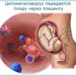 Опасность цитомегаловируса заключается в том, что он передается от матери ребенку в утробе
