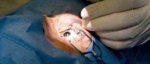 Операции при кровоизлиянии в стекловидное тело глаза