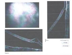Оптическая когерентная томография сетчатки - ОКТ