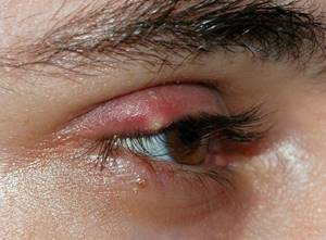 Опухло веко над глазом и болит: причины и быстрое лечение