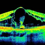 Edematous maculopathy of the retina causes and symptoms