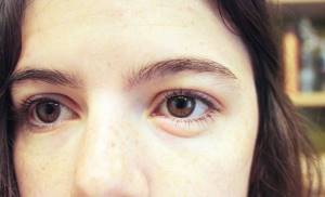 Отек глаз при аллергии - как быстро снять опухлость