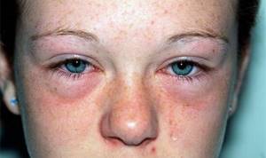 Отек глаз при аллергии