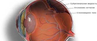 Retinal detachment