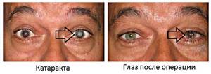 Отзывы и цены на операцию по замене хрусталика глаза при катаракте