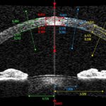 Пахиметрия - норма