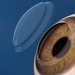 Пересадка роговицы глаза - операция