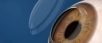 Cornea transplant - surgery