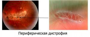Периферическая хориоретинальная дистрофия сетчатки глаза (ПХРД)