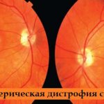 Периферические дистрофии сетчатки обоих глаз
