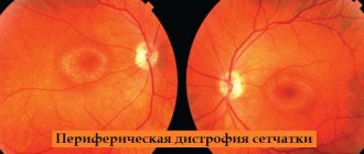 Peripheral retinal dystrophies of both eyes
